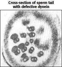 Cross-section of sperm tail with defective dynein