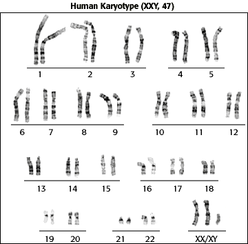 turner syndrome male karyotype