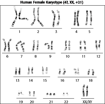 trisomy karyotype